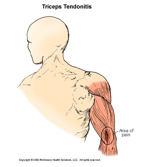 Sports Medicine Advisor 20031 Triceps Tendonitis Illustration