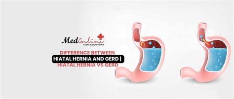 Difference Between Hiatal Hernia And Gerd