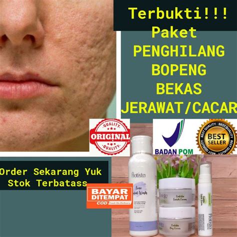 Mulai dari faktor genetis, perawatan wajah berjerawat yang salah dan lainnya. Paket Cream Penghilang Bopeng Ampuh Pratista /Obat Bopeng ...