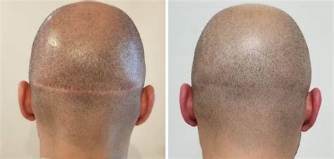 Fut And Fue Comparison Of Graft Scar And Differences Cosmeticium