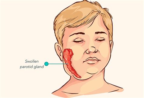 Mumps In Kids Reasons Signs And Treatment