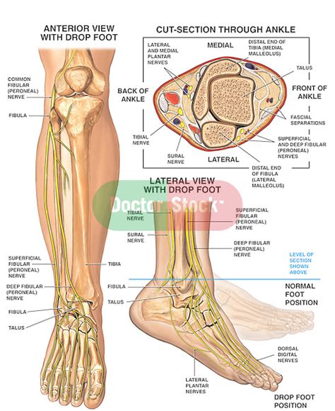 Anatomy of the Foot and Ankle with Foot Drop Deformity | Doctor Stock