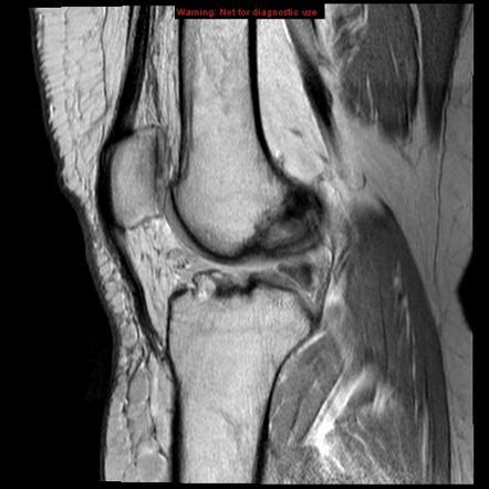 The acl arises from the front of the medial femoral condyle and passes through the middle of the knee to attach between the bony outcroppings (called the tibia spine) that are located between the tibia plateaus. Anterior cruciate ligament tear - complete | Image ...