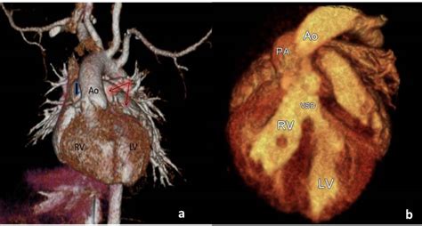 Three Dimensional Computed Tomography Reconstruction Image A