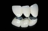 Pictures of Silver Crowns Teeth Cost