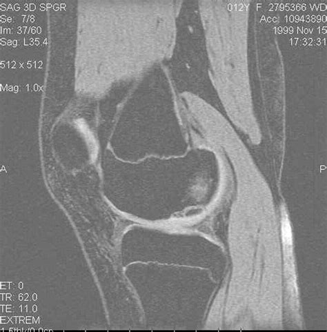 Fixation Of Unstable Osteochondritis Dissecans Lesions Of The Knee