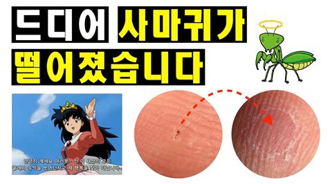 The hpv can cause tissue changes in the cervix of women with cervical. 드디어 사마귀를 치료했습니다! _how to Remove Wart #사마귀#사마귀제거#사마귀치료#사마귀 ...