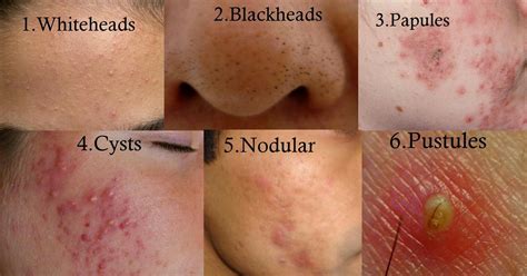 Types Of Acne Typesofacne Cystic Acne Treatment Diy Acne Treatment Back Acne Treatment