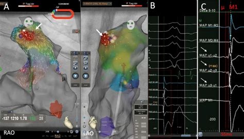 A Electroanatomic Map Of The Right Ventricle Utilizing Carto 3 V7