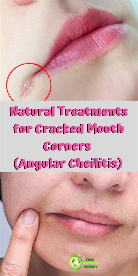 Causes And Remedies For Angular Cheilitis Cracked Lip Corners