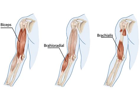 Distal Biceps Tendonitis