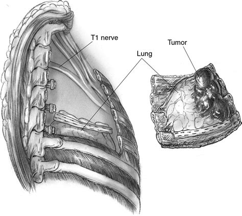 En Bloc Resection Of Thoracic Tumors Involving The Spine Operative