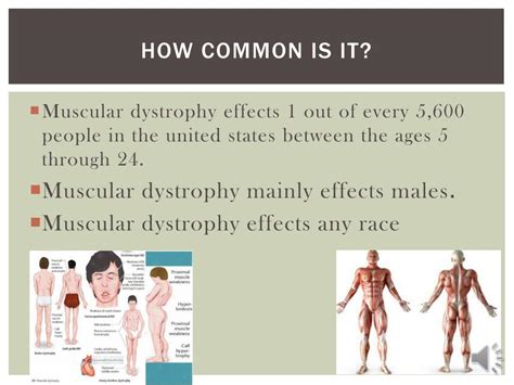 Ppt Muscular Dystrophy Powerpoint Presentation Free Download Id