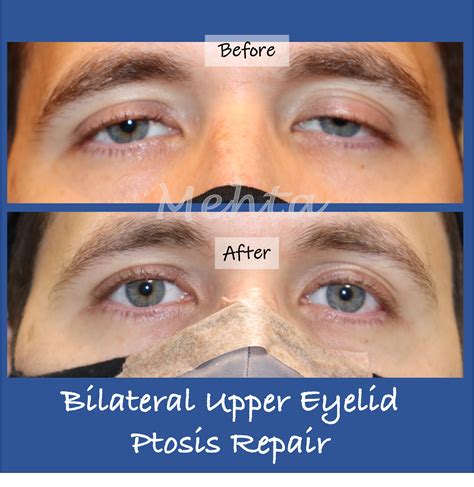 Ptosis Surgery Dc How To Fix Droopy Eyelids Washington Eye