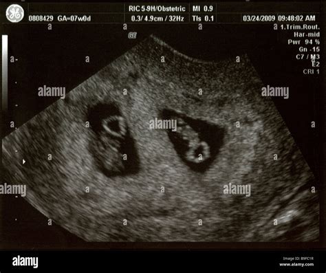 Ultrasound Showing Foetal Development Of Fraternal Twins At 7 Weeks