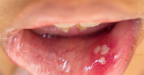 Hpv Bumps On Back Of Tongue Self Oral Cancer Screening Sexiezpicz Web