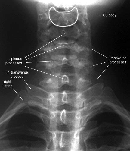 Cervical Spine Injuries