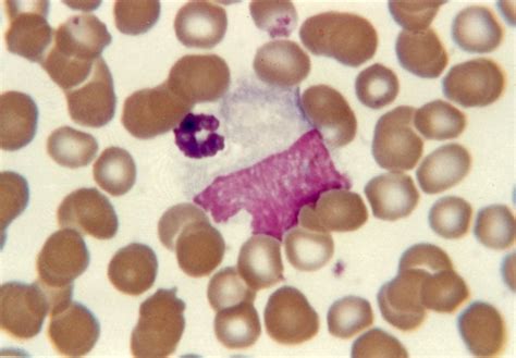 Degenerate Neutrophil Adherent To Monocyte Earlobe Blood Film