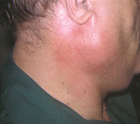 Fungal Infections Parotid