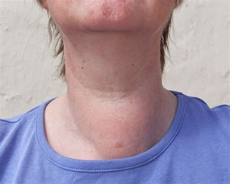 Partial Thyroidectomy Before And After Photos