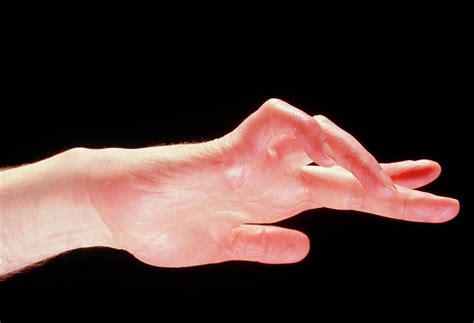 Claw Hand Due To Trapped Ulnar Nerve By Medical Photo Nhs Lothian