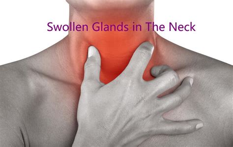 Swollen Glands In Neck12 Common Causes With Treatment