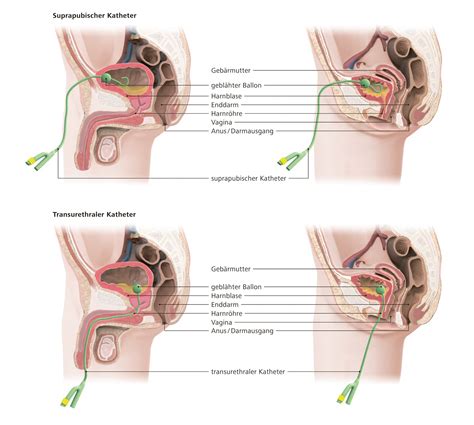 spdk suprapubischer dauerkatheter facharztzentrum münchen martinsried