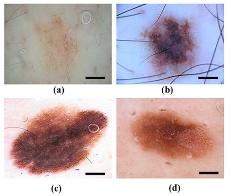 Difficulties Of Dermoscopic Images A Smooth Transition Between