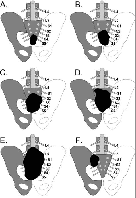 Categorization Of Sacral Resections After Fourney 54 A Low Sacral