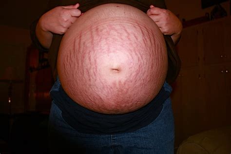 Skin Conditions Triggered By Pregnancy Safe Health Pc