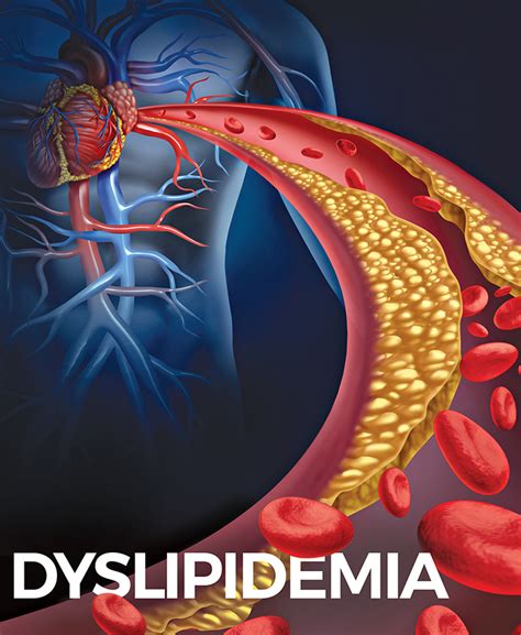 Dyslipidemia Images