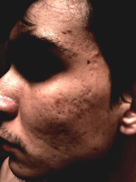 Acne Scar And Diagnosis Hypertrophic Raised Scars Forum