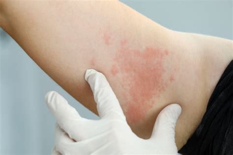Covid Symptoms Are Skin Rashes A Sign Of Coronavirus Metro News