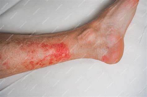 Maladie De La Peau Eczéma Sur Les Jambes éruptions Cutanées Et Taches