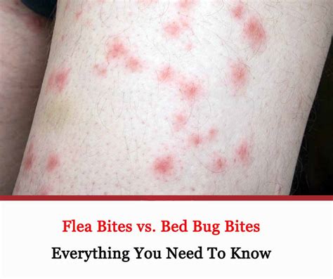 Bed Bug Bites Vs Other Bites Fleas Hives Chiggers 9 E