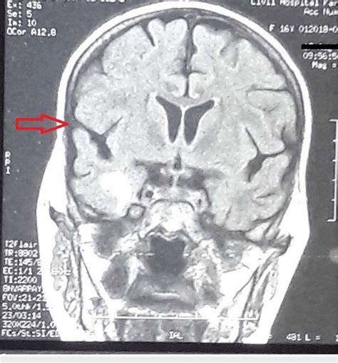 Brain Mri Coronal Section T1 Weighted Image Showing A Hypointense