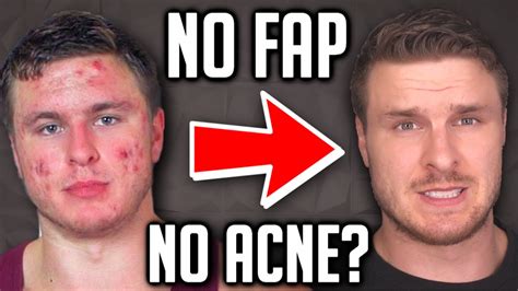 DOES MASTURBATION CAUSE ACNE My Experience YouTube