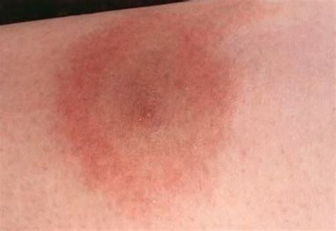 Erythema Migrans Pictures Symptoms Causes Treatment