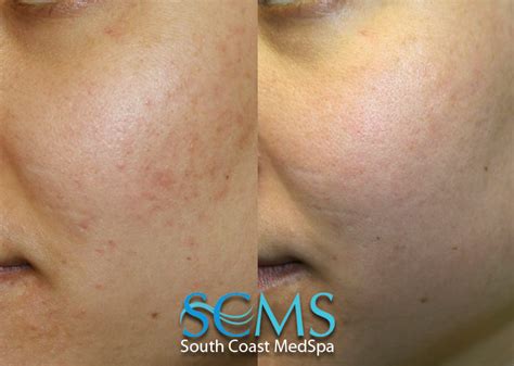 Laser Skin Resurfacing Before And After La San Diego