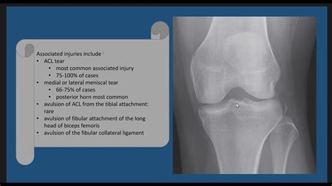 Segond Fracture Case Discussion YouTube