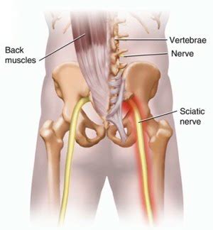 She really gets on my nerves. MASSAGE AND SCIATIC NERVE RELIEF | Body In Balance