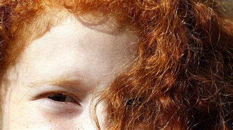 Ginger Gene Linked To Skin Cancer Risk