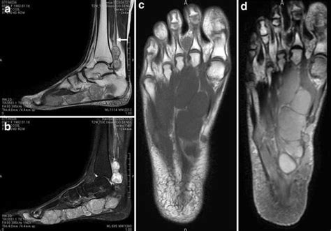 Magnetic resonance imaging (mri), with its multiplanar capabilities, superior soft tissue contrast, excellent spatial resolution, ability to image bone marrow, noninvasiveness, and lack… Magnetic resonance imaging of the right foot and ankle. a ...