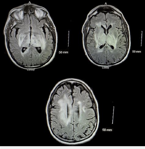 Mri Of The Brain Showing Diffuse Edema And Microhemorrhages Download