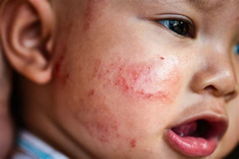 Baby Acne Causes Symptoms And What To Do About It Pregnancy And