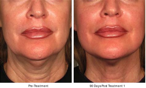 A Face And Neck Lift Without Surgery Greenwich Ct Patch
