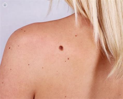 Saber Si Un Lunar Es Melanoma O Cáncer De Piel Top Doctors