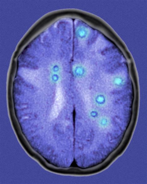 Secondary Brain Cancers Ct Scan Photograph By Du Cane Medical Imaging Ltd