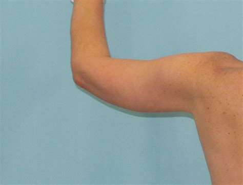 Brachioplasty Arm Lift Dr Sean Simon Plastic