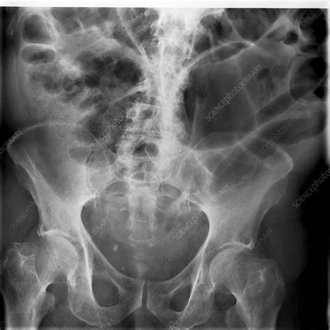 Large Bowel Obstruction X Ray Stock Image C0177855 Science